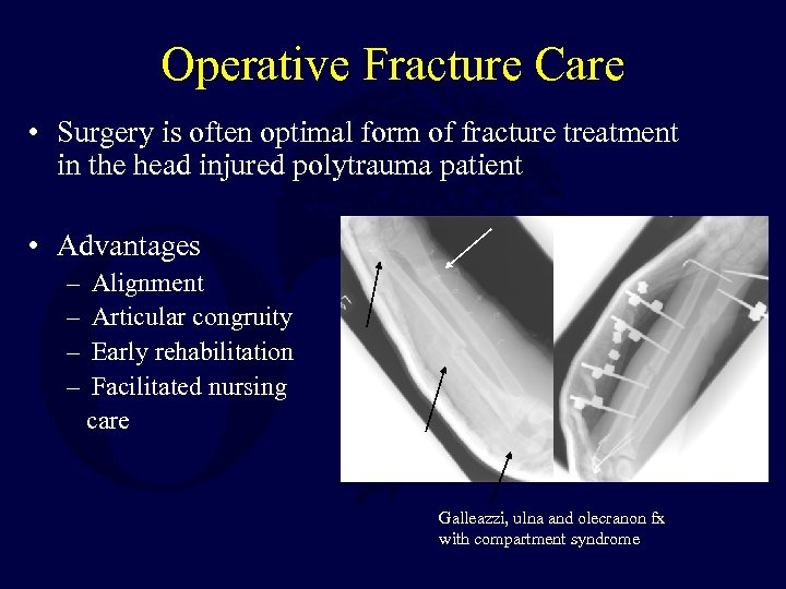 Operative Fracture Care • Surgery is often optimal form of fracture treatment in the