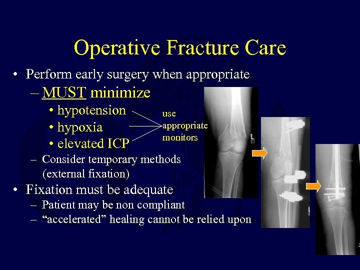 Operative Fracture Care • Perform early surgery when appropriate – MUST minimize • hypotension