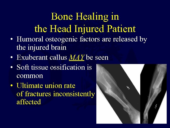 Bone Healing in the Head Injured Patient • Humoral osteogenic factors are released by