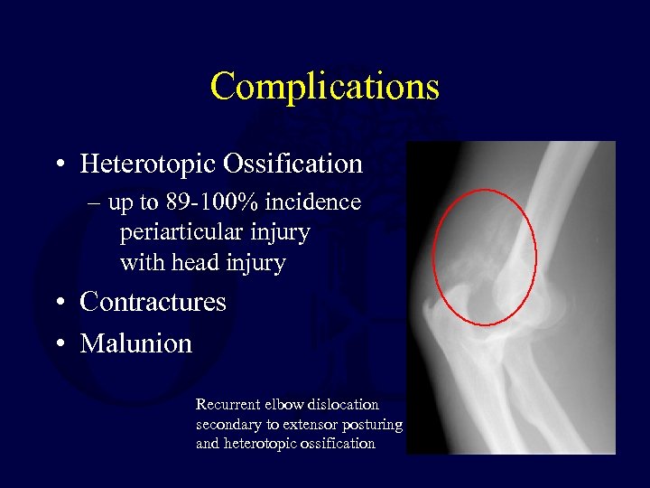 Complications • Heterotopic Ossification – up to 89 -100% incidence periarticular injury with head
