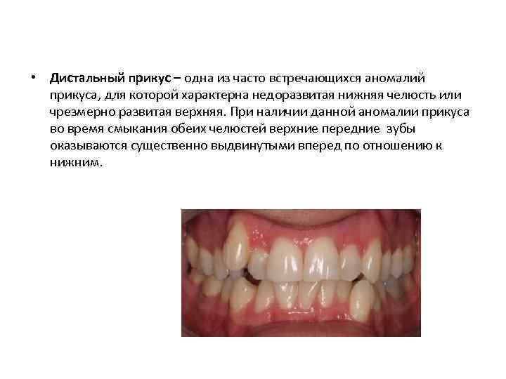  • Дистальный прикус – одна из часто встречающихся аномалий прикуса, для которой характерна