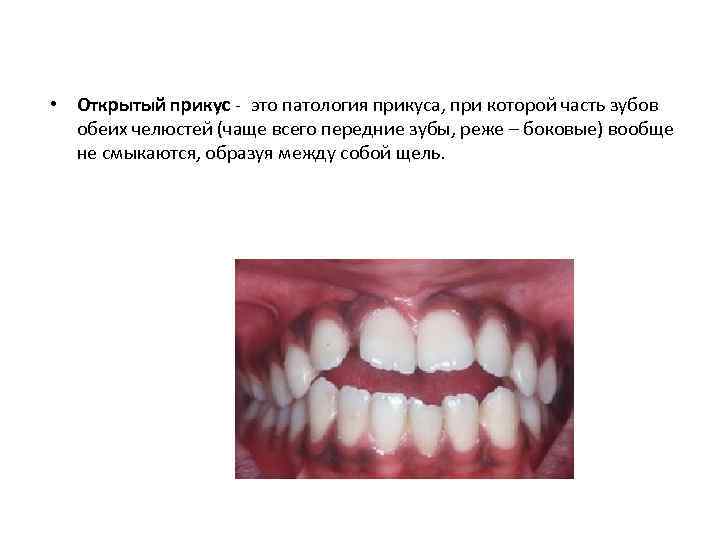  • Открытый прикус - это патология прикуса, при которой часть зубов обеих челюстей