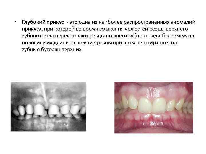  • Глубокий прикус - это одна из наиболее распространенных аномалий прикуса, при которой