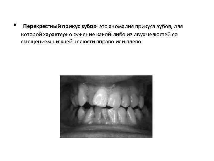  • Перекрестный прикус зубов- это аномалия прикуса зубов, для которой характерно сужение какой-либо