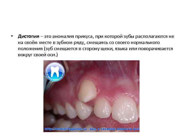  • Дистопия – это аномалия прикуса, при которой зубы располагаются не на своём