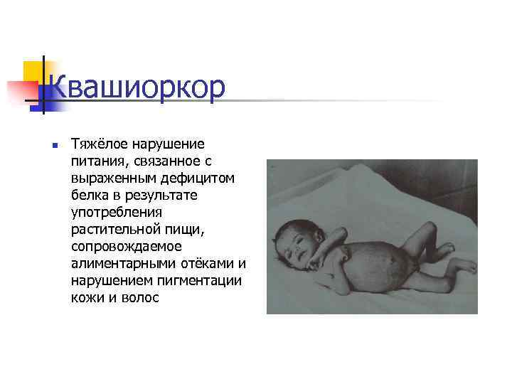Квашиоркор n Тяжёлое нарушение питания, связанное с выраженным дефицитом белка в результате употребления растительной
