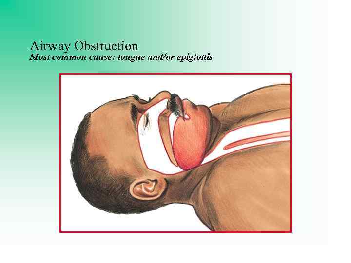 Airway Obstruction Most common cause: tongue and/or epiglottis 