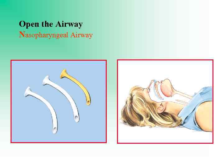 Open the Airway Nasopharyngeal Airway 