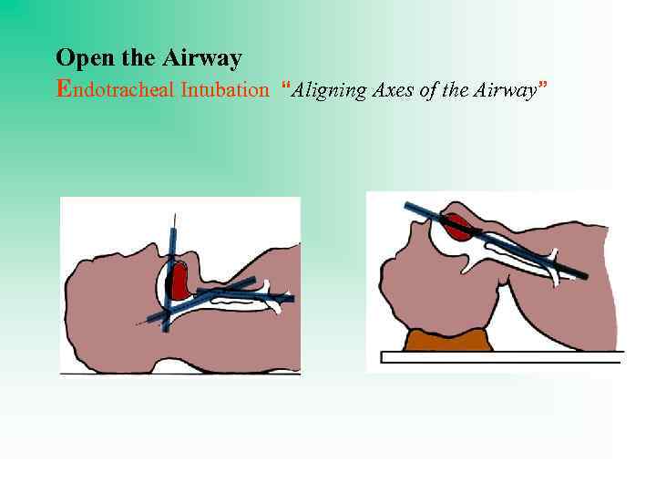 Open the Airway Endotracheal Intubation “Aligning Axes of the Airway” 