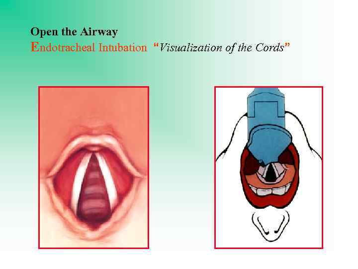 Open the Airway Endotracheal Intubation “Visualization of the Cords” 