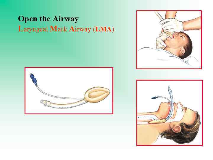 Open the Airway Laryngeal Mask Airway (LMA) 