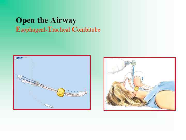 Open the Airway Esophageal-Tracheal Combitube 