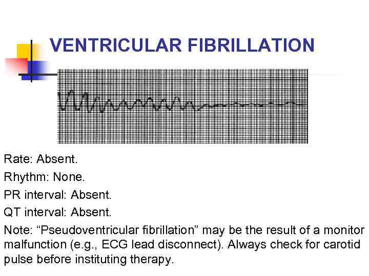 VENTRICULAR FIBRILLATION Rate: Absent. Rhythm: None. PR interval: Absent. QT interval: Absent. Note: “Pseudoventricular