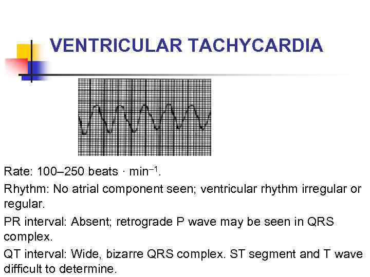 VENTRICULAR TACHYCARDIA Rate: 100– 250 beats · min– 1. Rhythm: No atrial component seen;