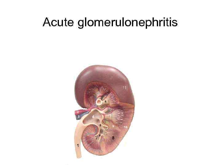 Acute glomerulonephritis 