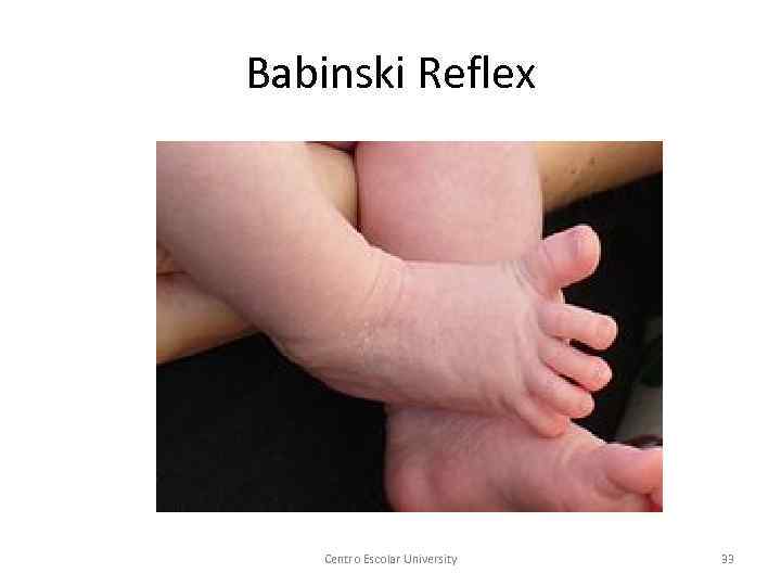 Babinski Reflex Centro Escolar University 33 