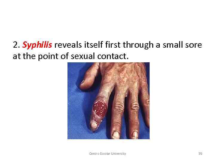 2. Syphilis reveals itself first through a small sore at the point of sexual