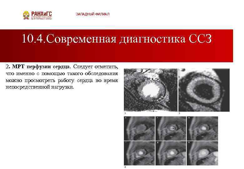 ЗАПАДНЫЙ ФИЛИАЛ 10. 4. Современная диагностика ССЗ 2. . МРТ перфузии сердца. Следует отметить,