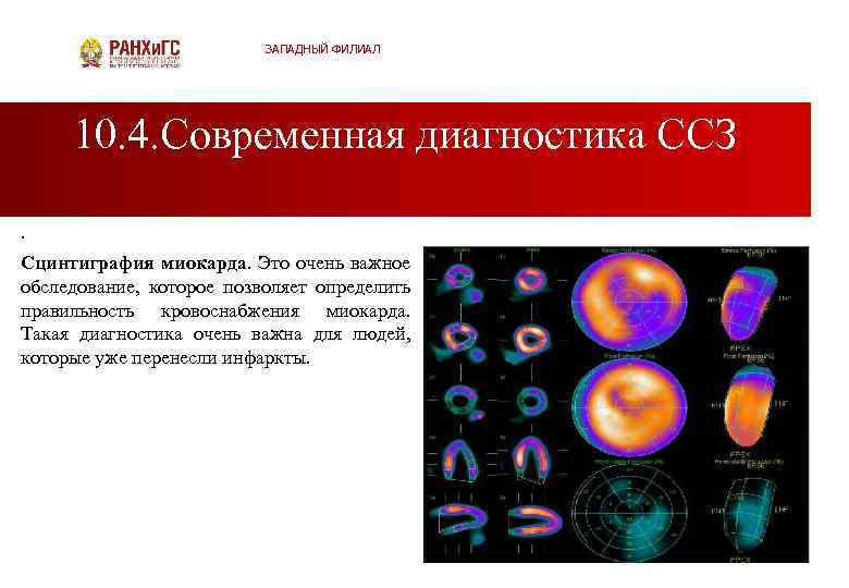 ЗАПАДНЫЙ ФИЛИАЛ 10. 4. Современная диагностика ССЗ. Сцинтиграфия миокарда. Это очень важное обследование, которое