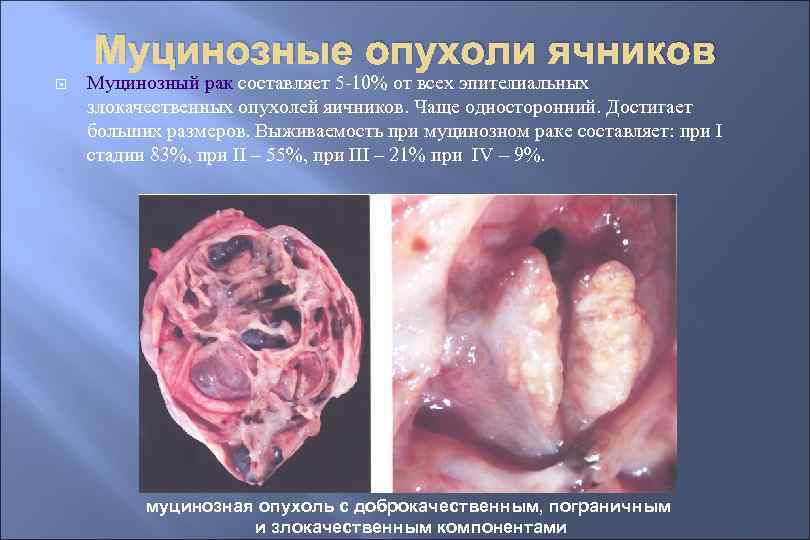 Муцинозные опухоли ячников Муцинозный рак составляет 5 -10% от всех эпителиальных злокачественных опухолей яичников.