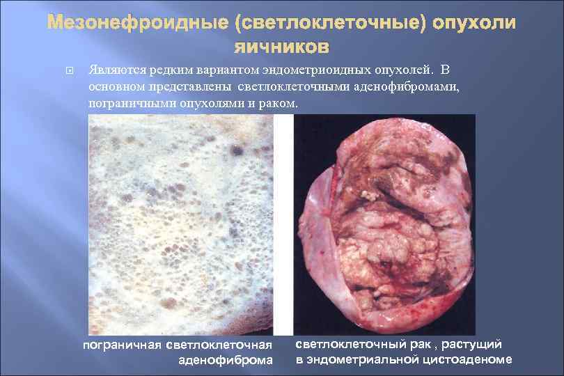 Мезонефроидные (светлоклеточные) опухоли яичников Являются редким вариантом эндометриоидных опухолей. В основном представлены светлоклеточными аденофибромами,