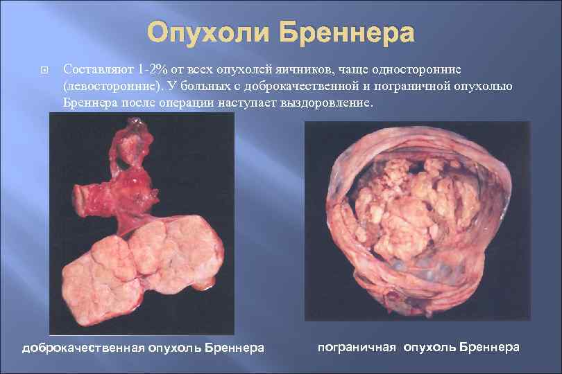 Опухоли Бреннера Составляют 1 -2% от всех опухолей яичников, чаще односторонние (левосторонние). У больных