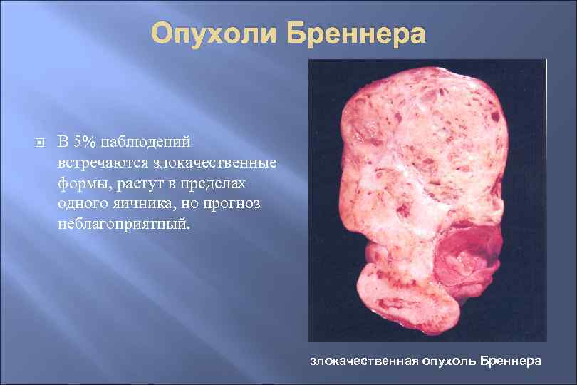 Опухоли Бреннера В 5% наблюдений встречаются злокачественные формы, растут в пределах одного яичника, но