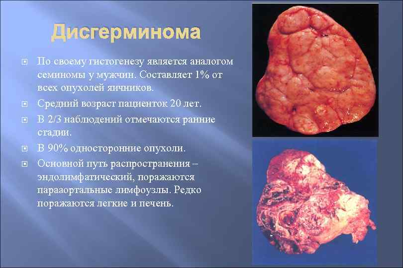 Дисгерминома По своему гистогенезу является аналогом семиномы у мужчин. Составляет 1% от всех опухолей