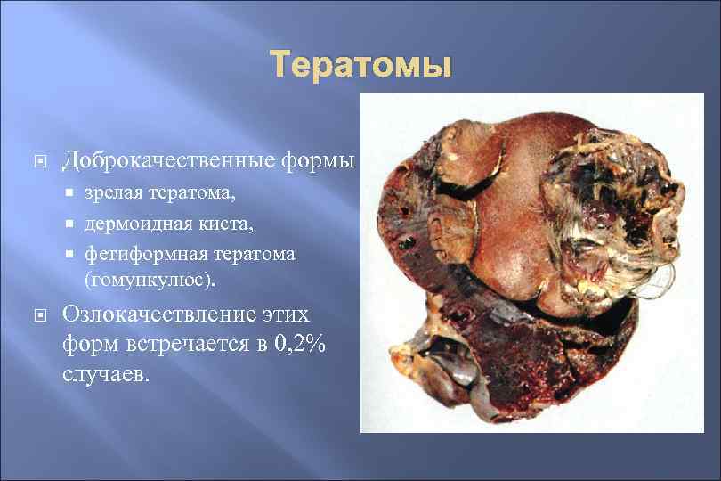 Тератомы Доброкачественные формы зрелая тератома, дермоидная киста, фетиформная тератома (гомункулюс). Озлокачествление этих форм встречается