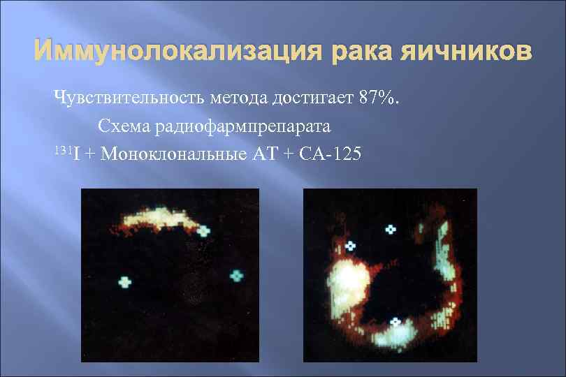 Иммунолокализация рака яичников Чувствительность метода достигает 87%. Схема радиофармпрепарата 131 I + Моноклональные АТ