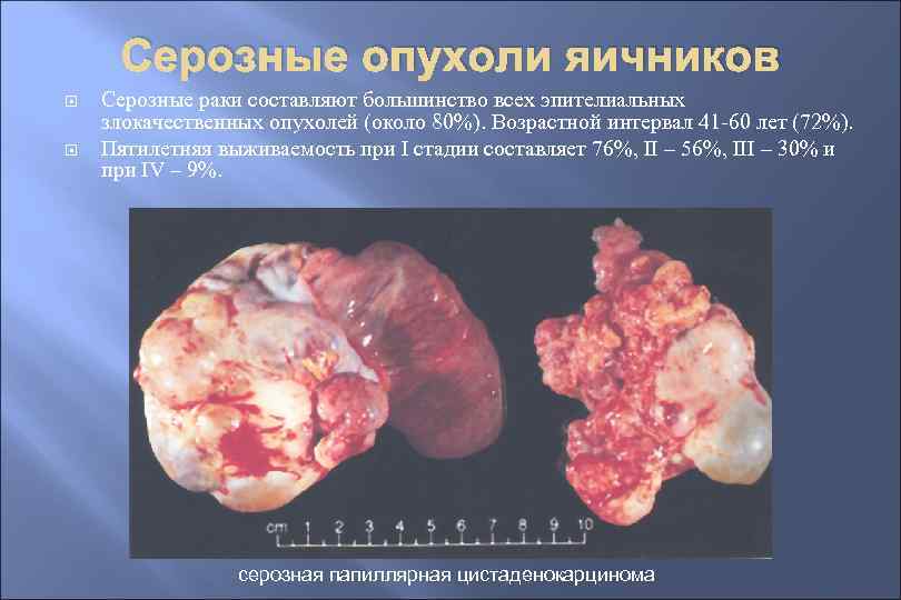 Серозные опухоли яичников Серозные раки составляют большинство всех эпителиальных злокачественных опухолей (около 80%). Возрастной