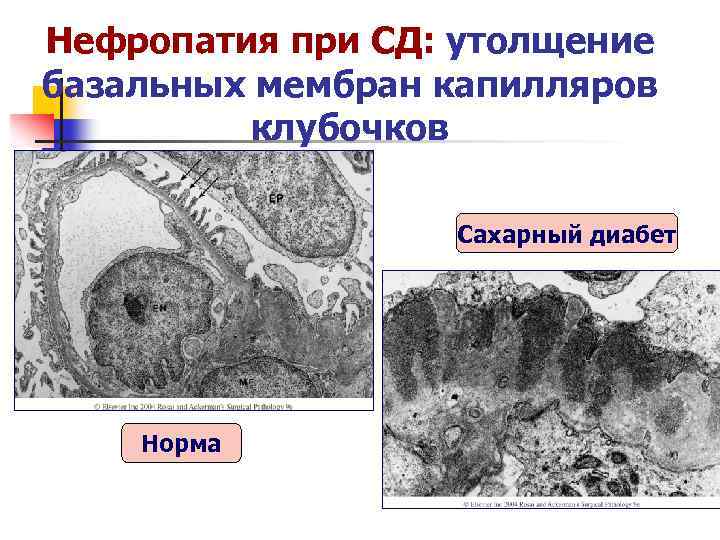 Нефропатия при СД: утолщение базальных мембран капилляров клубочков Сахарный диабет Норма 