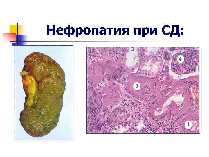 Нефропатия при СД: 