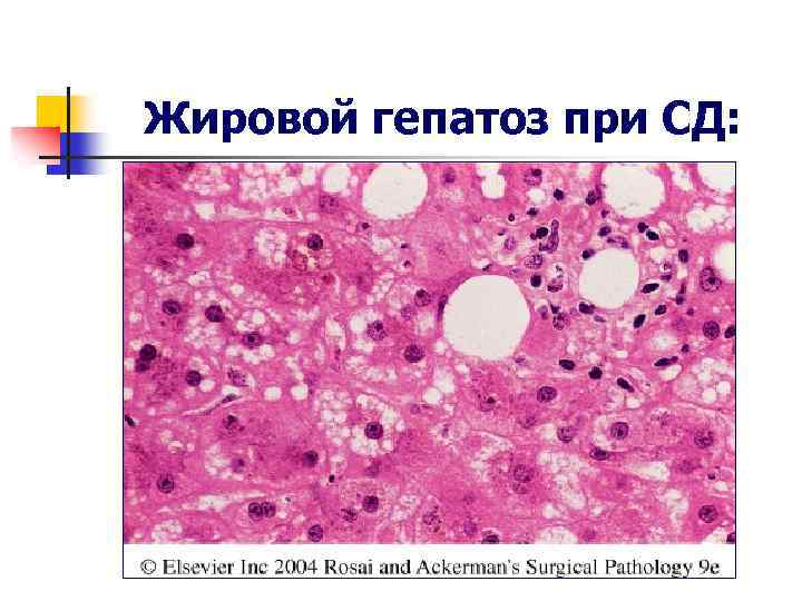 Жировой гепатоз при СД: 