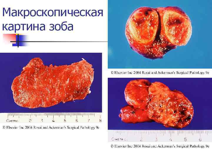 Макроскопическая картина зоба 