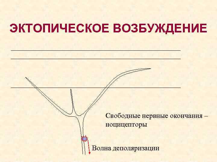 ЭКТОПИЧЕСКОЕ ВОЗБУЖДЕНИЕ Свободные нервные окончания – ноцицепторы Волна деполяризации 