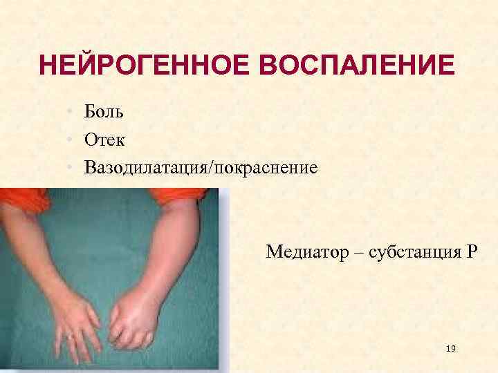 НЕЙРОГЕННОЕ ВОСПАЛЕНИЕ • Боль • Отек • Вазодилатация/покраснение Медиатор – субстанция Р 19 