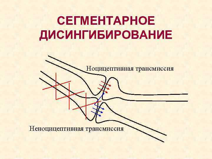 СЕГМЕНТАРНОЕ ДИСИНГИБИРОВАНИЕ Ноцицептивная трансмиссия Неноцицептивная трансмиссия 