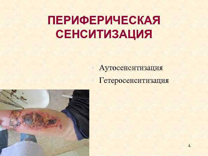 ПЕРИФЕРИЧЕСКАЯ СЕНСИТИЗАЦИЯ • Аутосенситизация • Гетеросенситизация 4 