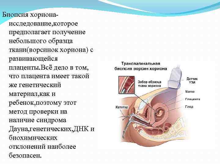 Биопсия хорионаисследование, которое предполагает получение небольшого образца ткани(ворсинок хориона) с развивающейся плаценты. Всё дело