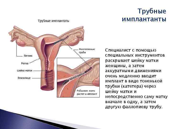 Трубные имплантанты Специалист с помощью специальных инструментов раскрывает шейку матки женщины, а затем аккуратными