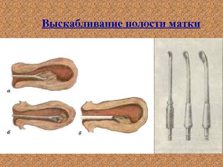 Выскабливание полости матки 