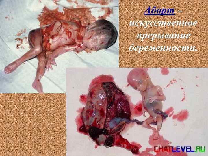 Аборт – искусственное прерывание беременности. 