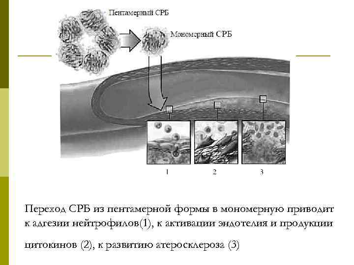 Переход СРБ из пентамерной формы в мономерную приводит к адгезии нейтрофилов(1), к активации эндотелия