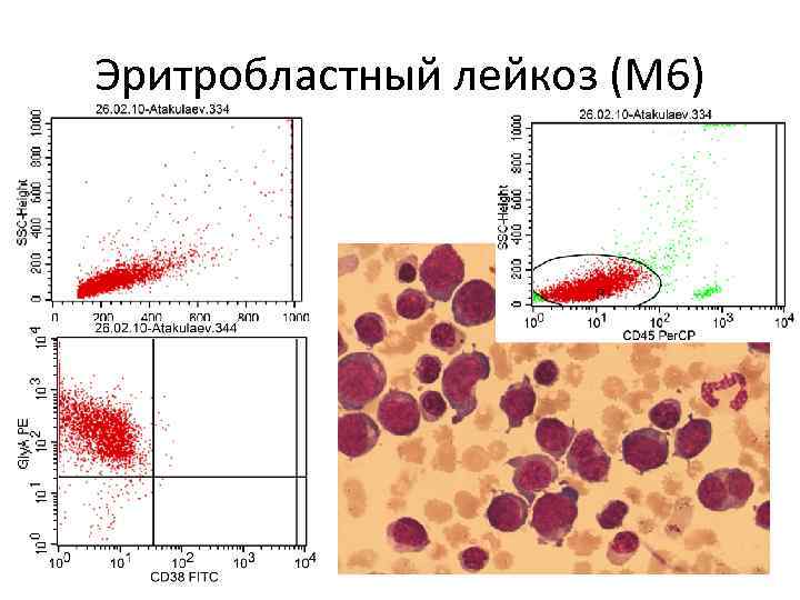 Эритробластный лейкоз (М 6) 