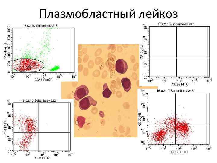 Плазмобластный лейкоз 