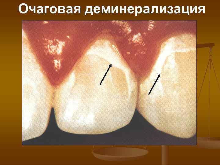 Очаговая деминерализация 