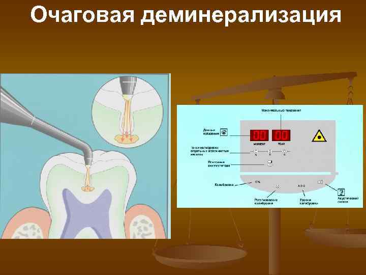 Очаговая деминерализация 