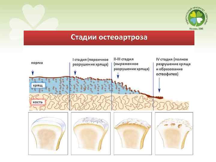 Стадии остеоартроза 