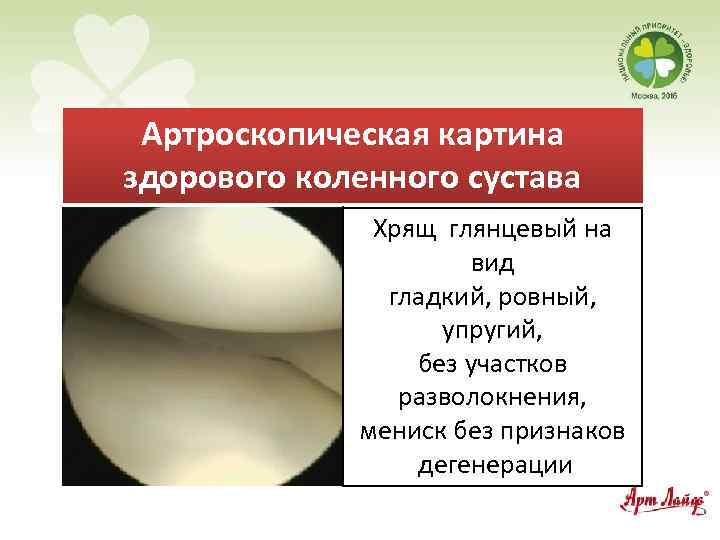 Артроскопическая картина здорового коленного сустава Хрящ глянцевый на вид гладкий, ровный, упругий, без участков